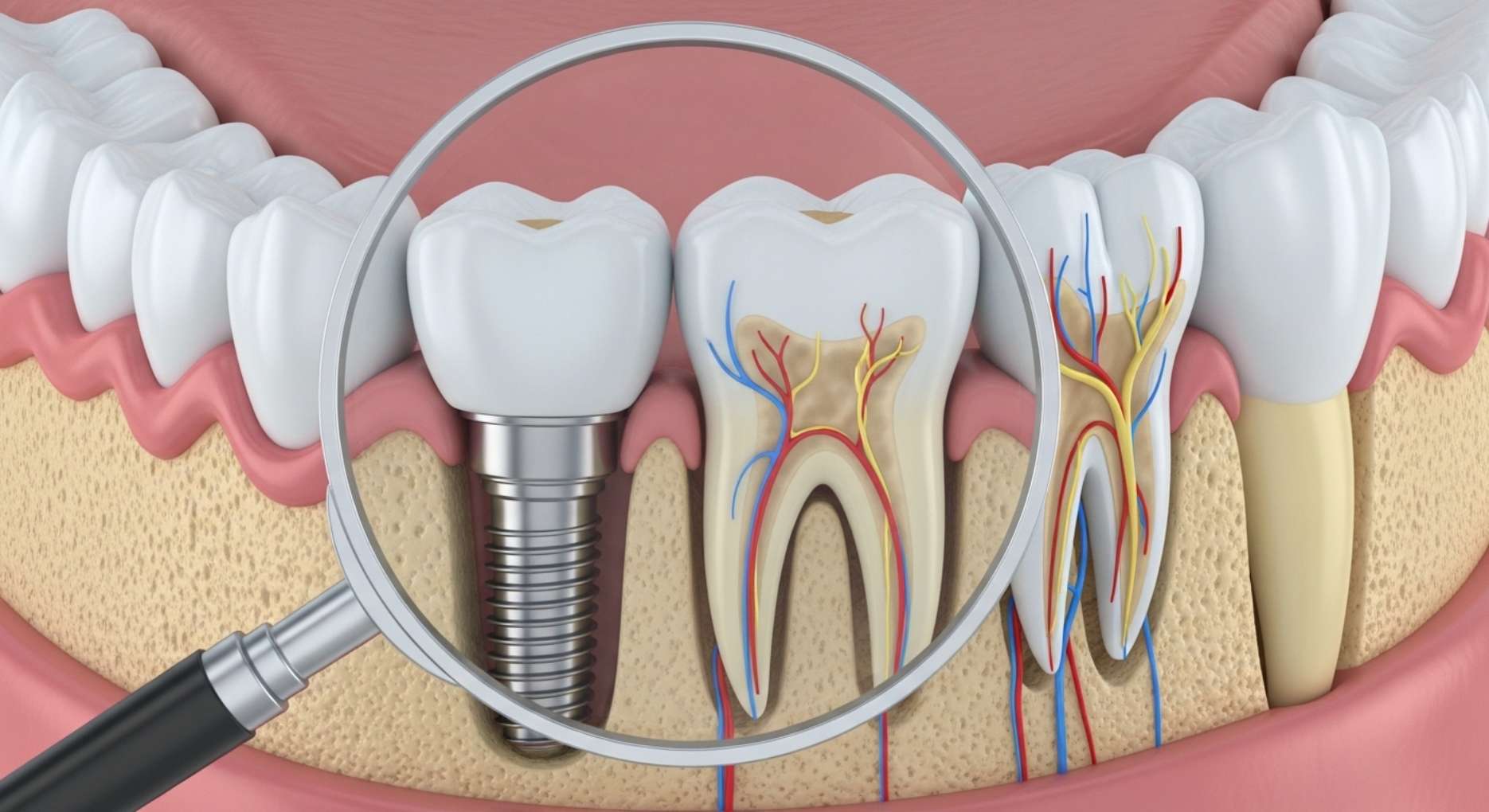 자연치아와 임플란트의 신경 유무 차이를 보여주는 3D 일러스트