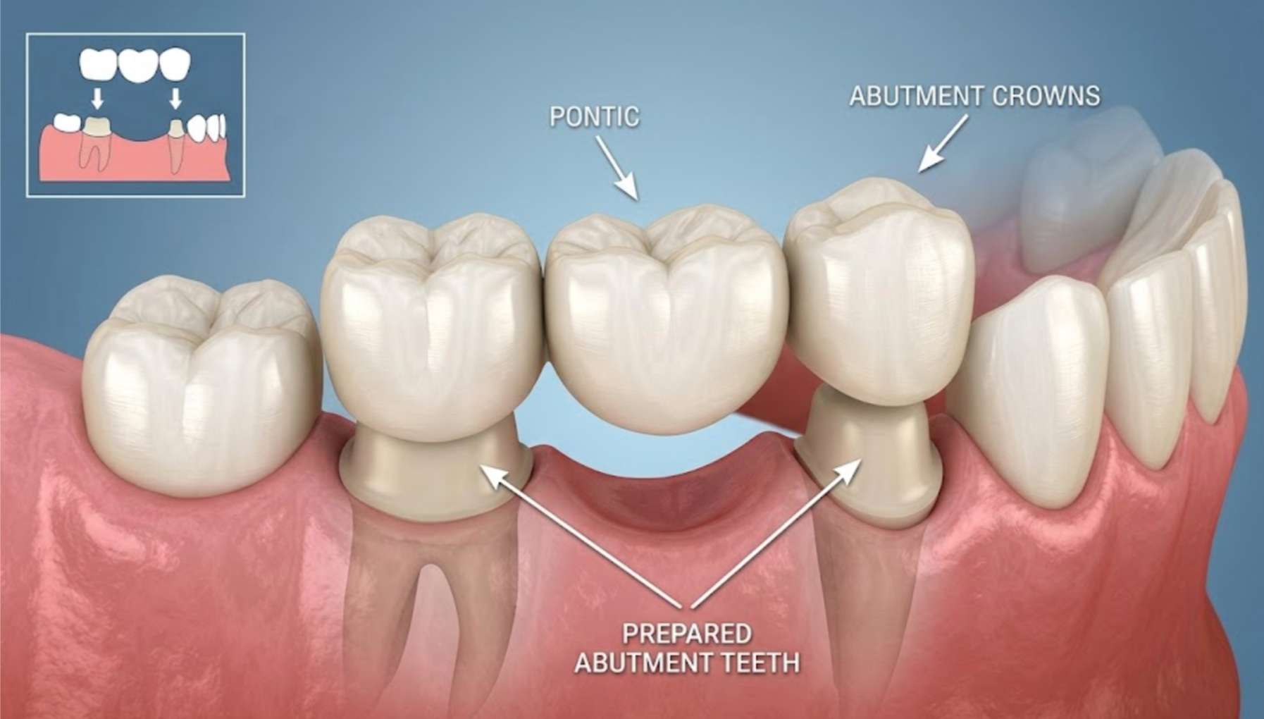치아브릿지2 양옆 치아를 다리처럼 연결하는 치아 브릿지 3D 일러스트