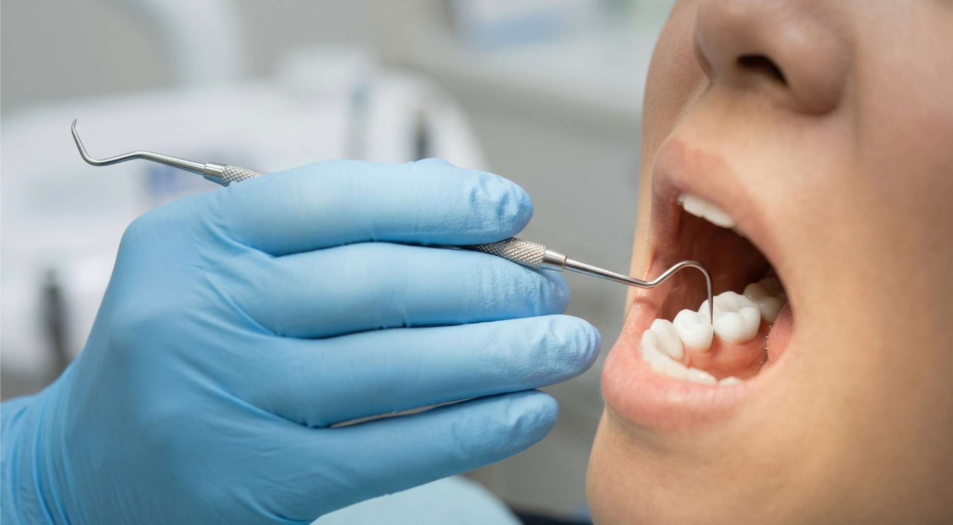 파란색 의료용 장갑을 낀 치과 의사가 탐침 기구를 이용해 환자의 어금니 인접면 충치를 검사하는 클로즈업 사진