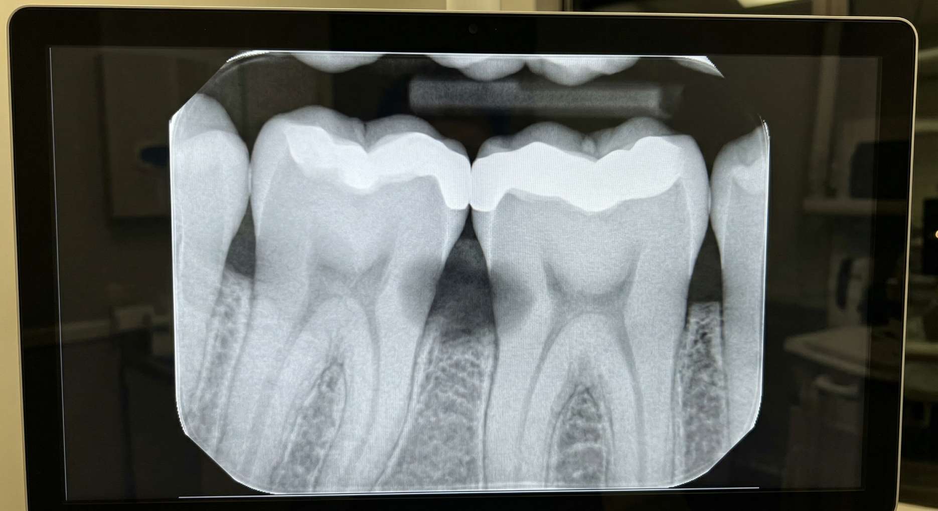 치아와 치아 사이가 까맣게 썩은 인접면 충치 병소가 명확하게 나타난 치과 구내 방사선 엑스레이 사진