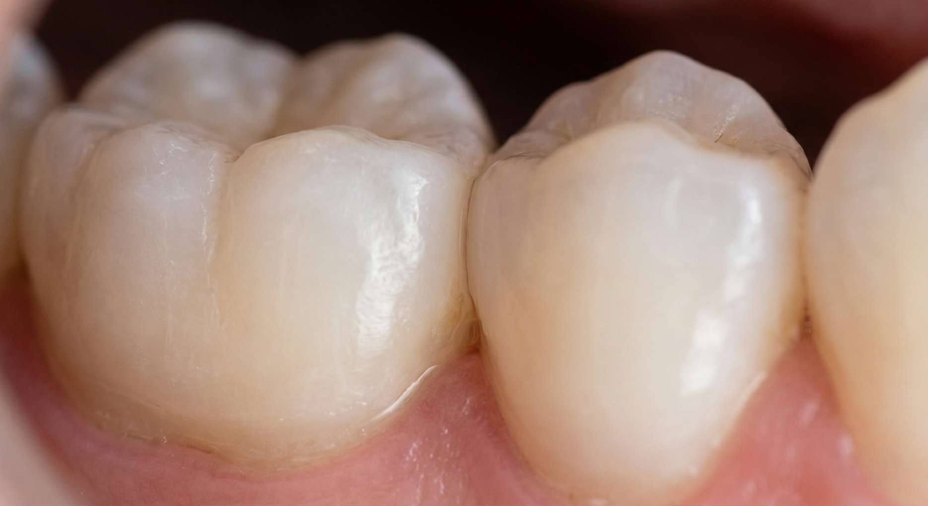 음식물이 끼기 쉽고 충치가 발생하기 쉬운 좁은 틈새를 가진 두 어금니 치아 사이 맞닿은 부분 클로즈업