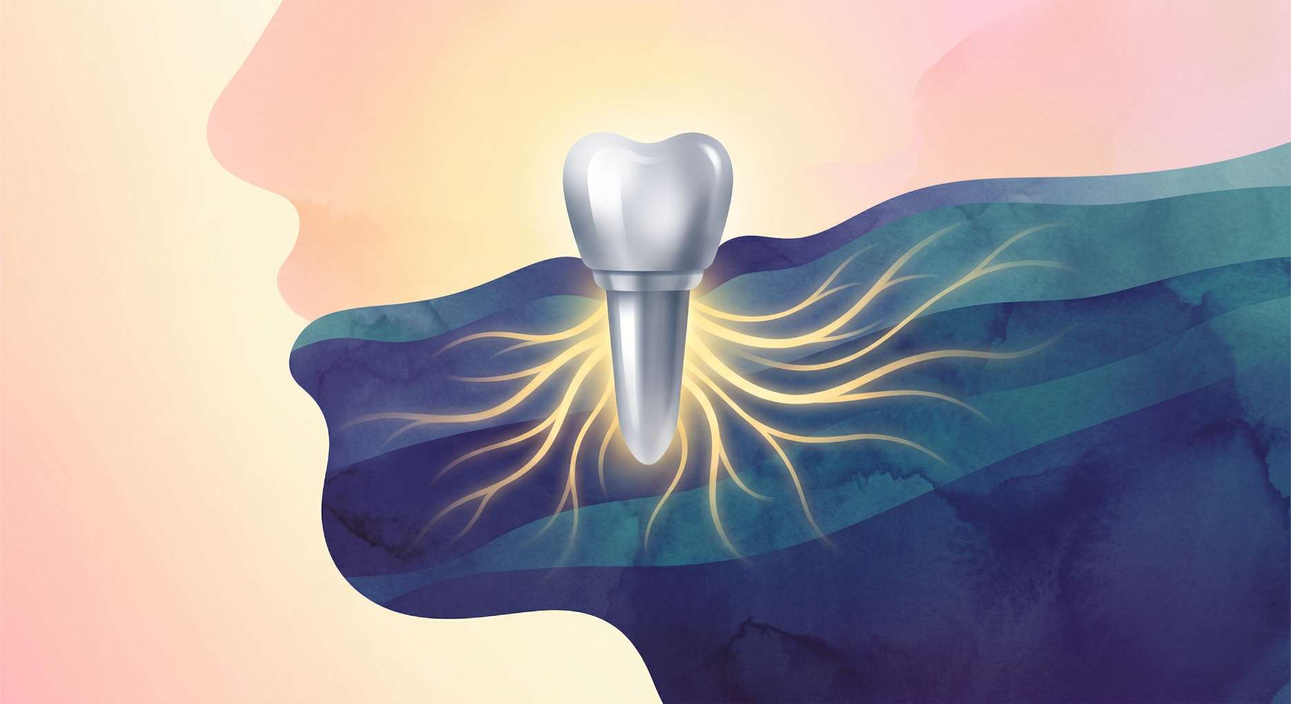 임플란트 2차 수술3 잇몸 뼈와 임플란트 픽스처가 단단히 결합된 골유착(Osseointegration) 과정을 나타낸 일러스트