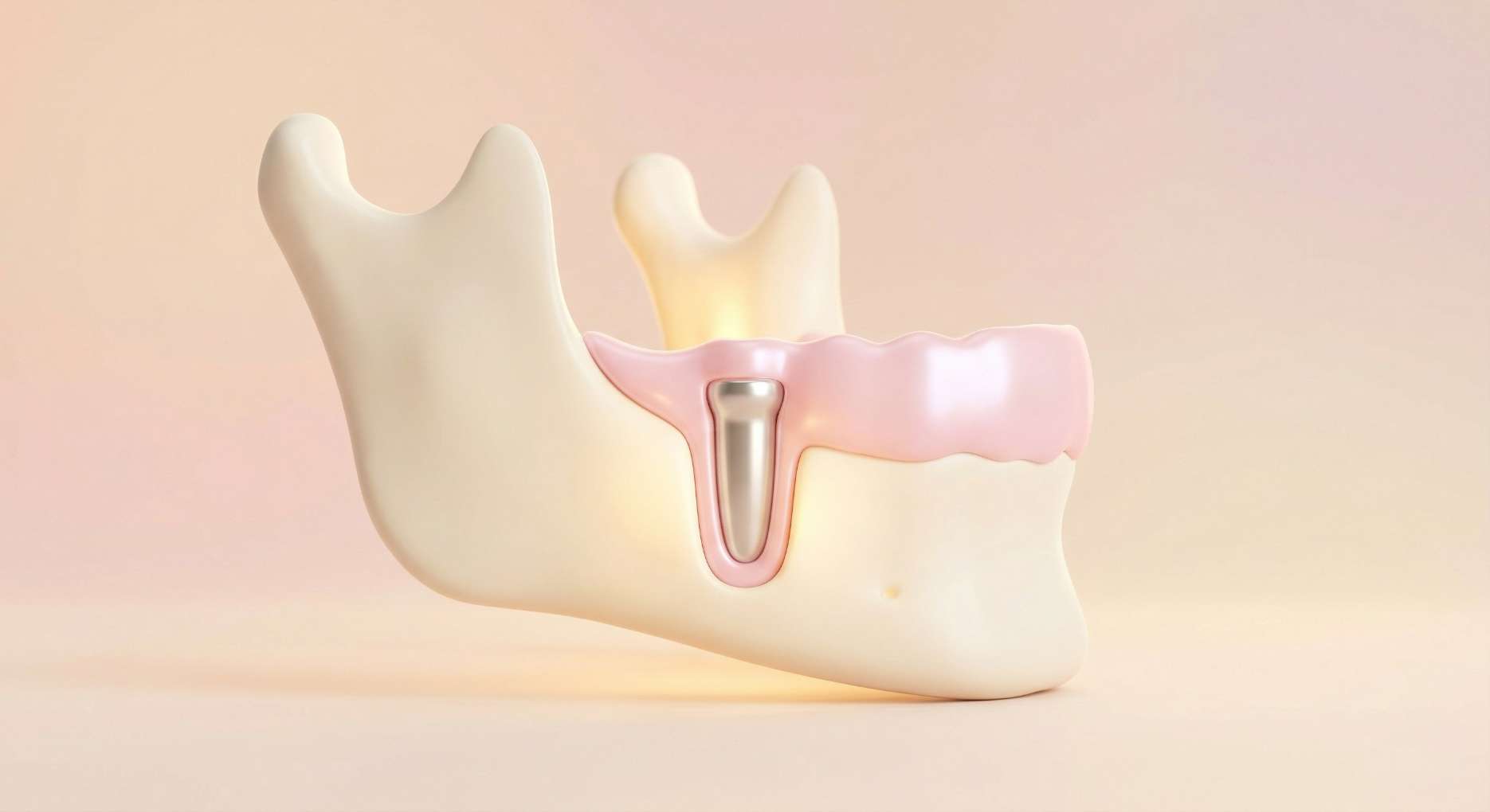 임플란트 2차 수술7 하악골 잇몸 뼈 내부에 안정적으로 식립된 임플란트 픽스처 3D 모델링