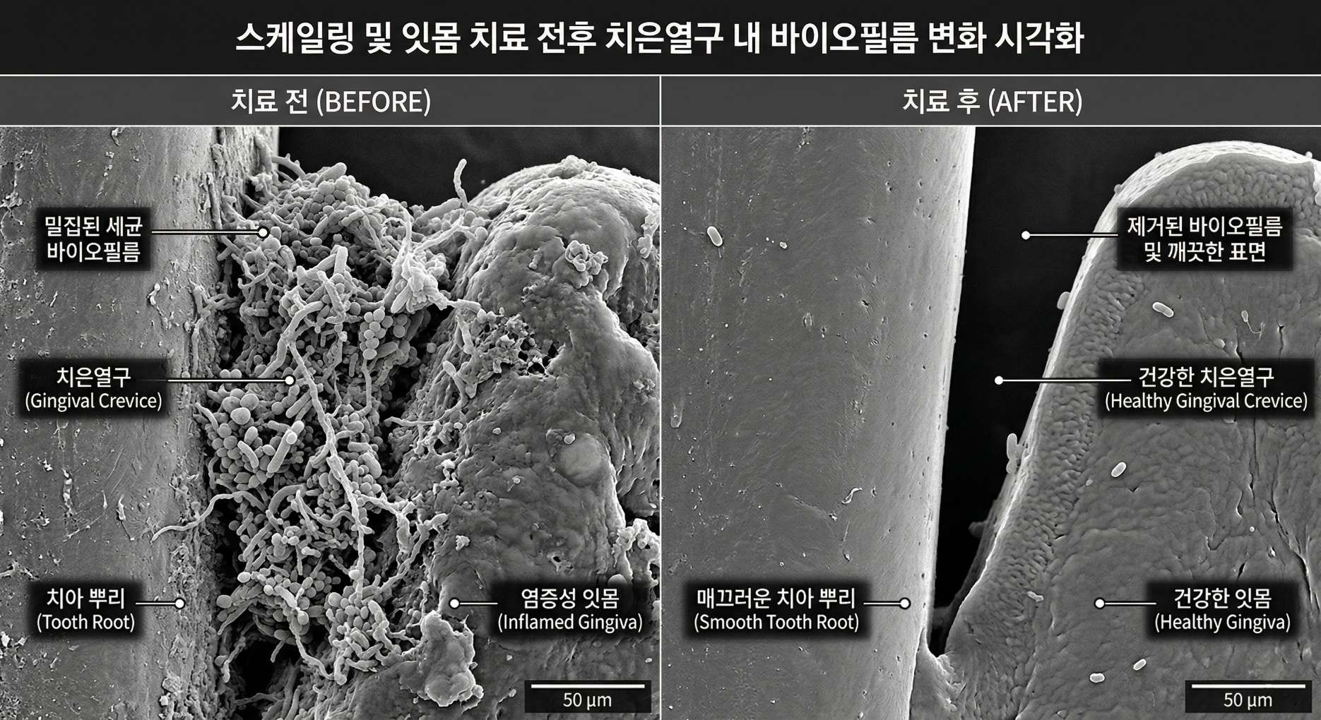 임플란트 잇몸치료12 스케일링 및 잇몸 치료 전후 치아 뿌리와 치은열구 내 세균 바이오필름(세균막) 변화를 보여주는 전자 현미경 확대 시각화 이미지