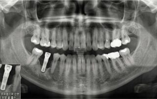 임플란트 주위염으로 인해 픽스처 주위의 잇몸뼈가 깔때기 모양으로 심각하게 흡수된 파노라마 엑스레이 사진