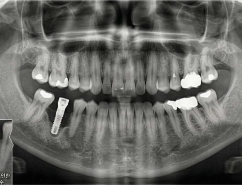 [울산 치과]임플란트 전 잇몸치료, 과잉 진료일까? 필수인 이유