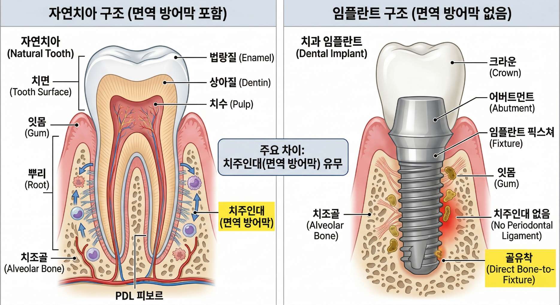 임플란트 잇몸치료4 면역 방어막 역할을 하는 치주인대의 유무를 중심으로 자연치아와 임플란트의 구조적 차이를 비교한 단면 일러스트