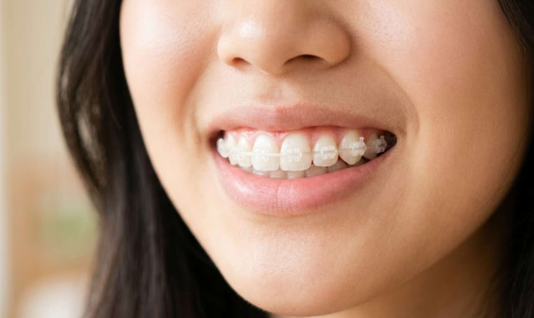 청소년 치아교정10 눈에 잘 띄지 않는 세라믹 교정기를 착용하고 부드럽게 미소 짓는 깨끗한 치아 클로즈업