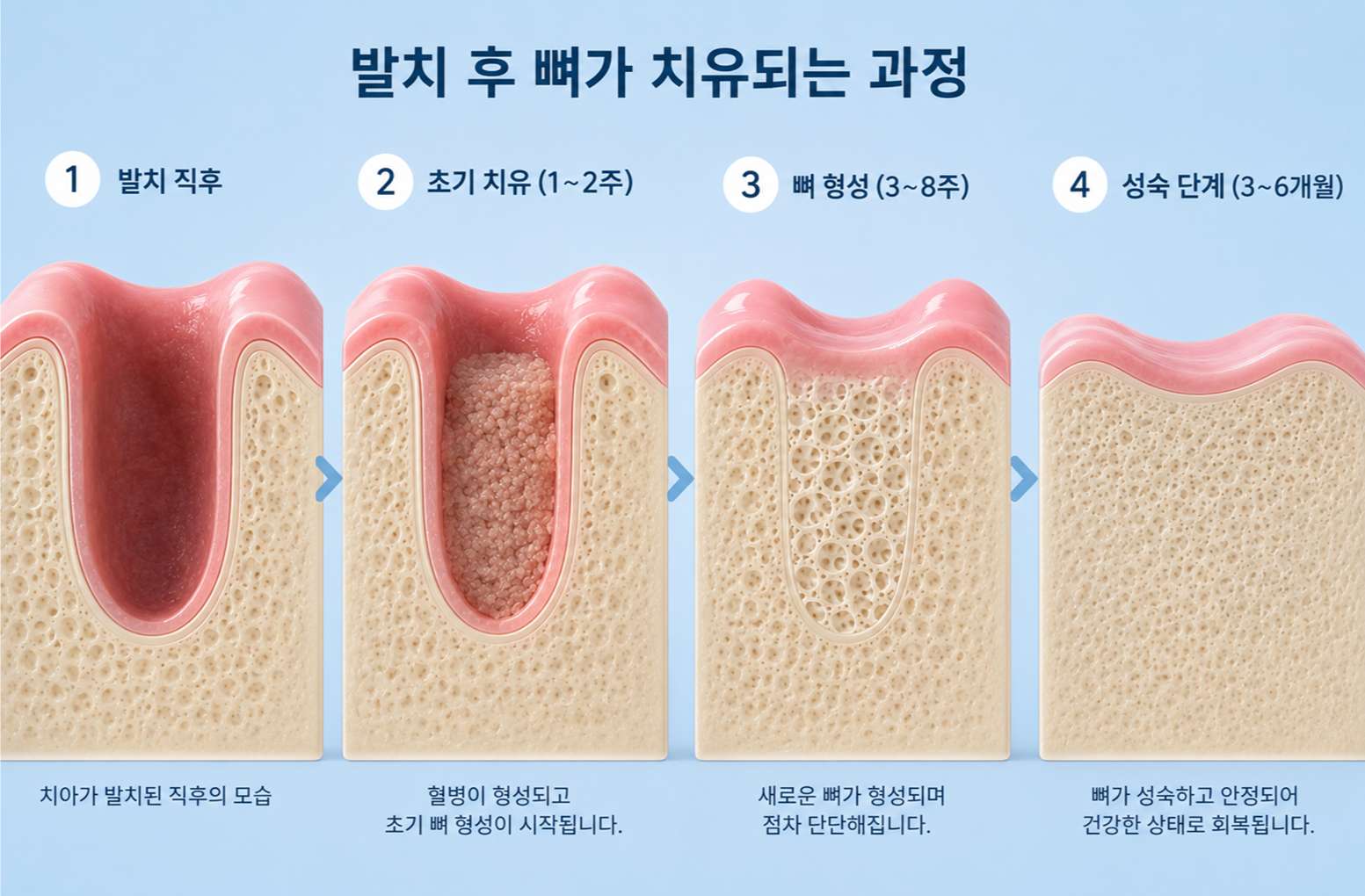 임플란트 당일 식립8 발치 후 빈 공간에 하얗고 튼튼한 새 뼈 조직이 촘촘하게 차오르는 모습을 보여주는 깨끗한 3D 일러스트