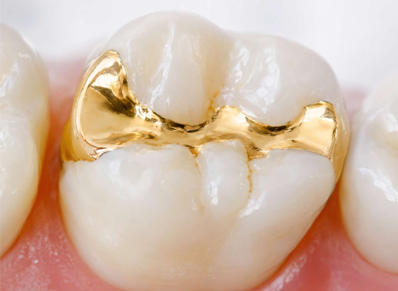 충치 치료 후 시림3 하얀 어금니 모형에 정밀하게 채워진 금(Gold) 인레이 보철물