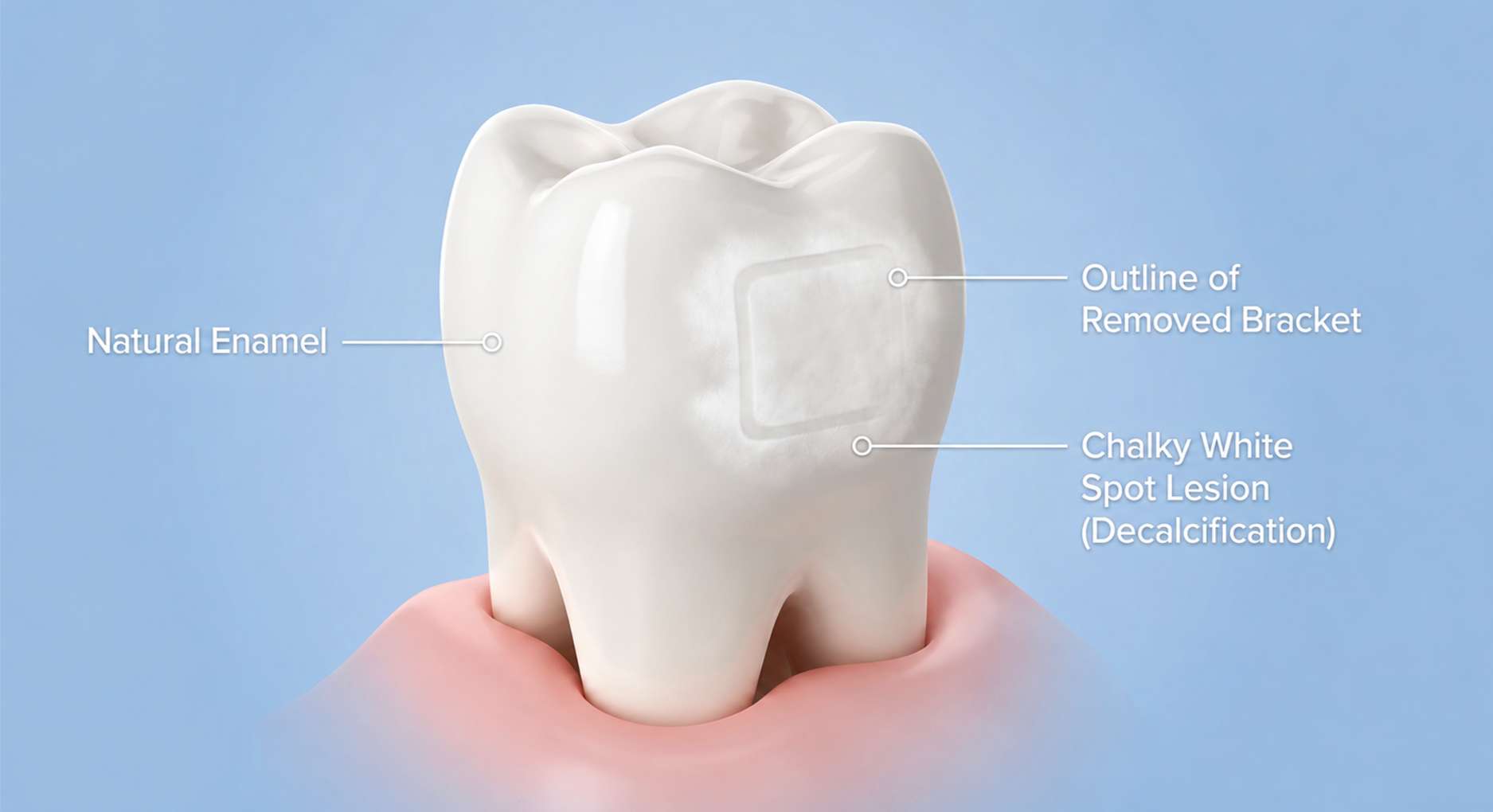 치아 탈회6 교정 장치가 있던 자리 주변으로 잇몸과 치아 경계에 하얀 탈회가 진행된 모습을 보여주는 일러스트