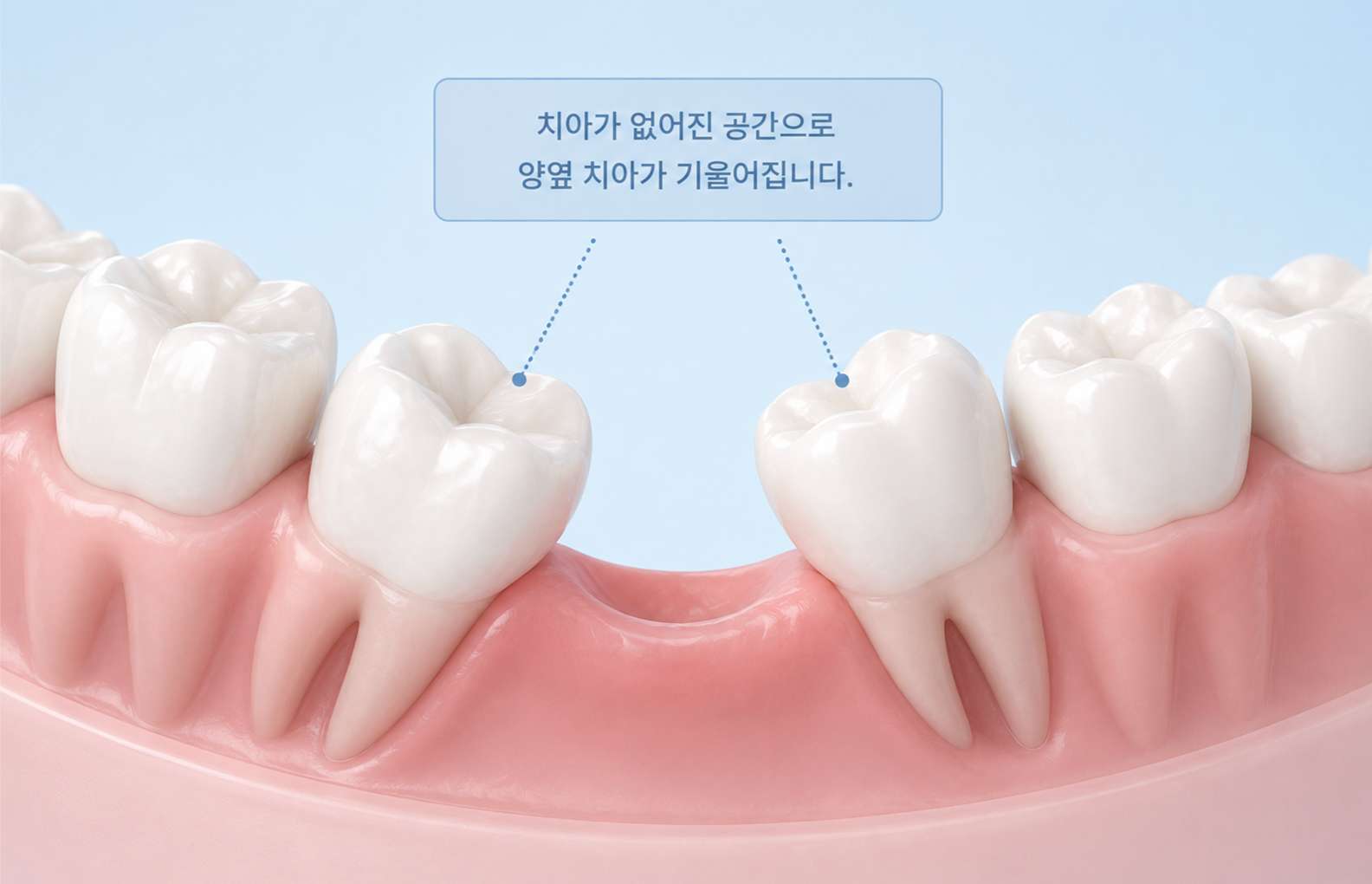 어금니가 빠진 빈 공간으로 주변 치아들이 서서히 기울어지는 모습을 보여주는 3D 일러스트