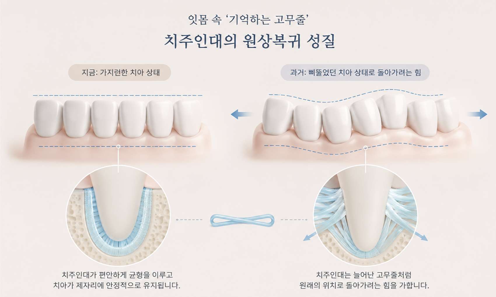 교정 후 치아를 원래 위치로 되돌리려는 주변 조직의 힘과 유지장치의 역할을 표현한 3D 교육용 일러스트