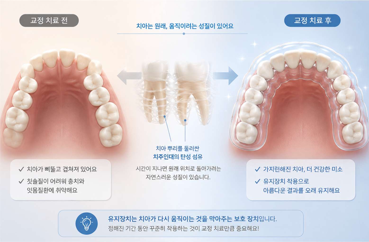 교정 전의 불규칙한 치열과 교정 후 가지런해진 치열, 그리고 유지장치의 역할을 비교한 3D 교육용 이미지
