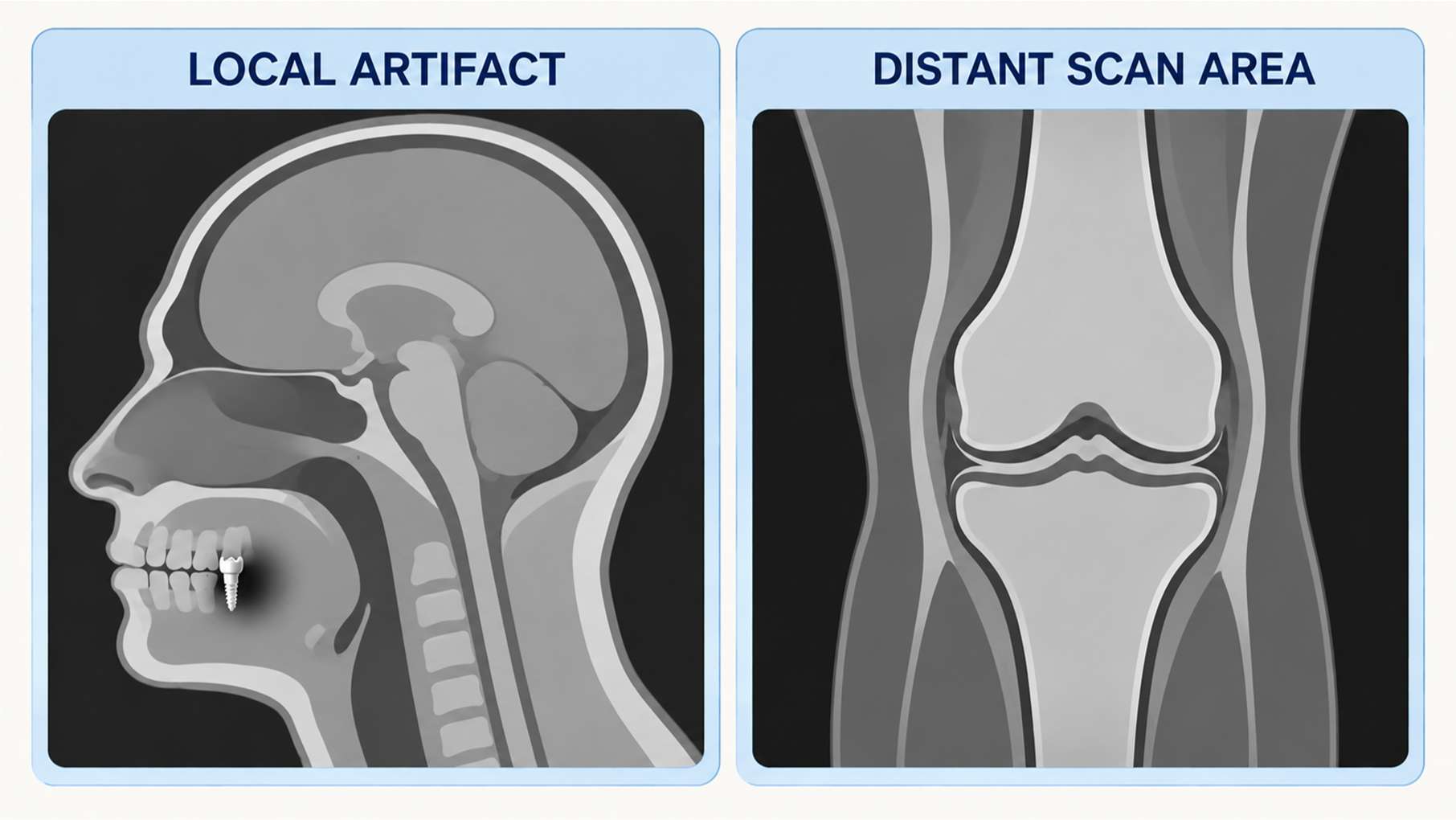 임플란트 MRI3 임플란트 주변의 국소적인 MRI 영상 왜곡과 멀리 떨어진 촬영 부위 비교
